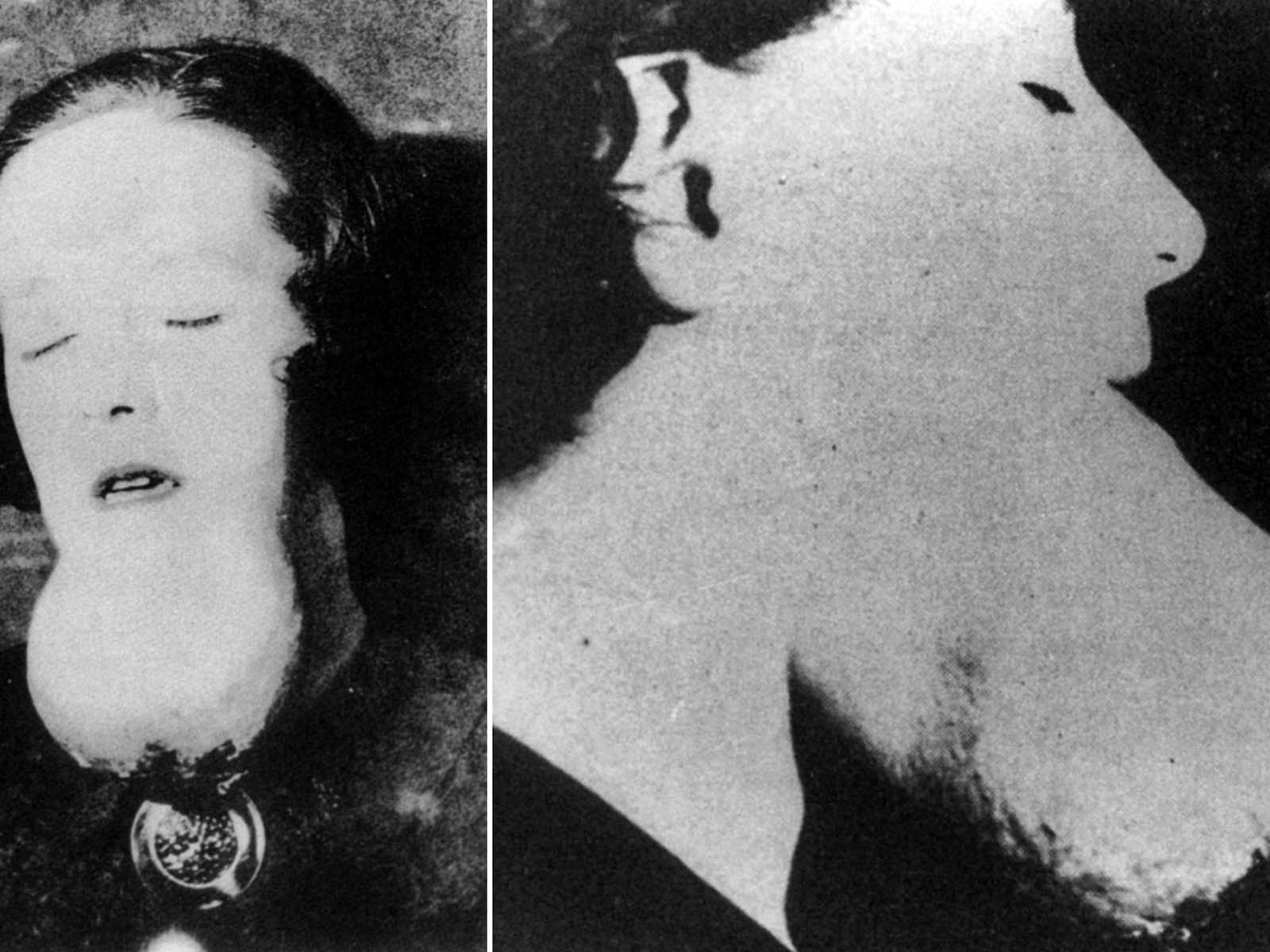 radium jaw fell off
